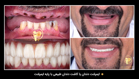 ایمپلنت فوری _ ایمپلنت یک روزه